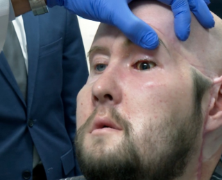 Dünya’nın ilk göz nakli ABD’de yapıldı