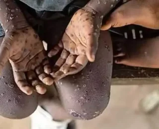 Maymun Çiçeği Afrika’da endişelendiriyor